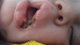 美國19個月大女嬰舔了手機充電器，嘴角慘遭灼傷潰爛（圖／翻攝自靠北醫師臉書）