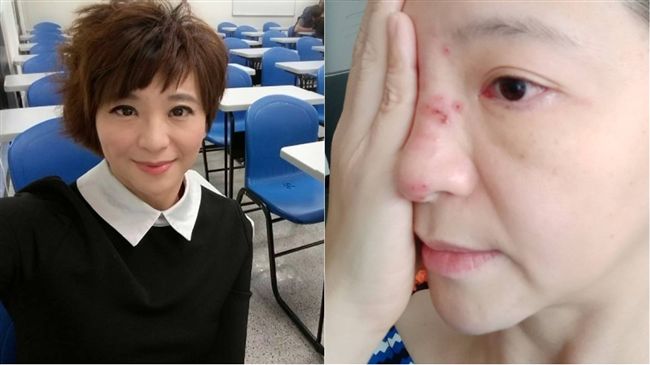 女主播染帶狀皰疹險瞎　公開毀容照