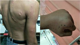 蚊子叮變蜂窩性組織炎。（圖／臉書「爆廢公社二館」）