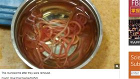 印度,活蟲,圓蟲,膽管,醫生,手術,腹痛,寄生蟲,發燒,嘔吐
https://www.livescience.com/62461-roundworms-bile-ducts.html
