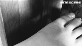 踢到桌腳以為僅瘀青　女子最後切大拇指保命