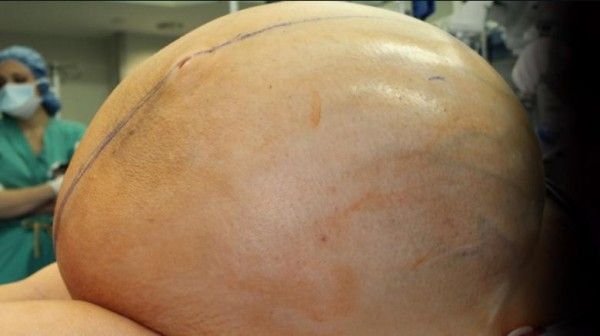 婦便秘成「大腹」！結果竟是巨大腫瘤