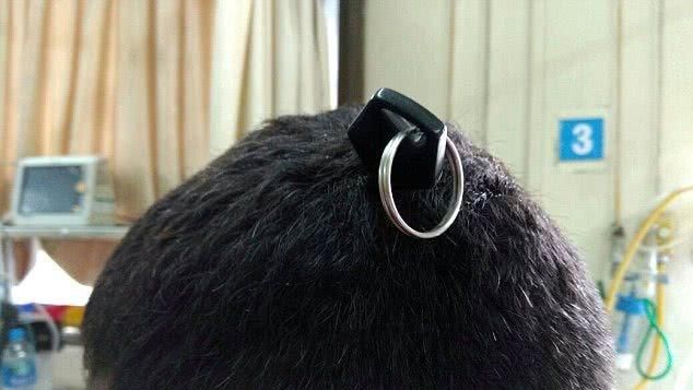 與人吵架遭車鑰匙插腦　男竟大難不死