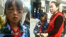 大陸黑龍江省慶安縣一名女童遭繼母虐打，女童雙眼睜不開來，眼周除了紅腫外，還有一圈紫黑色的瘀青，如同「熊貓眼」。女童稱臉上的傷是繼母打的，但繼母出現直喊「誰說我打的，誰看到是我打的？」目前當地警方已介入調查，女童也已送往醫院接受檢查和治療。（圖／翻攝自秒拍）