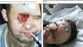 英國一名58歲退休園丁杭特（Danny Hunt）先前常因頭痛就醫，但他被醫師誤診為偏頭痛，直到他去看眼科才得知罹患眼癌。杭特為了抗癌，決定動手術拿掉右眼、部分骨頭，導致他的臉部變形，他無奈嘆「連孫子看到他都會害怕！」（圖／翻攝自每日郵報）