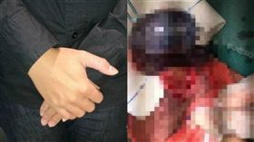 睪丸扭轉 圖／翻攝自醫學手札 https://mp.weixin.qq.com/s/85BdhpZFGuA1vZQLwcITJg