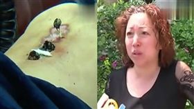 針灸,扎針,腰疼,大陸,郎中,失禁,知覺,治療,補償,性生活　圖／翻攝自北青網　https://goo.gl/vSQm23