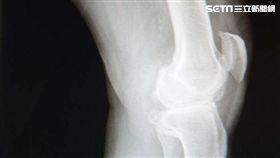 手術,膝關節,童綜合醫院,MAKOplasty,機器人手臂,膝關節置換手術,謝國顯