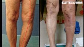 O型腿,台南市立安南醫院,骨科,關節,張伯羣,膝關節,安南醫院