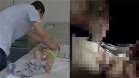 生殖器,磁鐵,男童,大陸,西安,好奇心,尿道,止血鉗,異極相吸,損傷,排尿,夾住　圖／翻攝自看看新聞　https://goo.gl/aSbkSQ