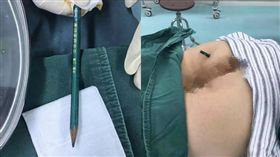 同學惡作劇，18公分鉛筆插進他屁股。（圖／翻攝搜狐網）