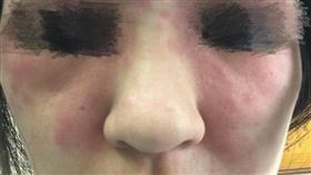 有一名女網友逛接時遇到一名櫃姐強迫推銷，櫃姐「從14萬的課程一路推銷到1萬多」，最後女網友花5000元做美容課程，不料課程結束後，她的臉部出現紅腫過敏現象。其他網友看到後，紛紛直呼「快去看皮膚科，然後直接提告！」（圖／翻攝自《爆怨公社》）