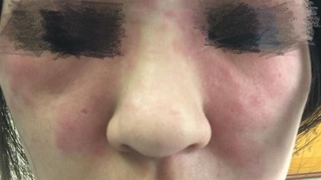 櫃姐強迫推銷　美女砸5千美容變豬頭