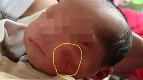 大陸河北一名醫師進行剖腹產手術時，不小心用手術刀將寶寶的左臉劃傷，傷口長達1.5公分，更誇張的是，醫師事後還沒告知家屬。目前醫師已遭醫院停職。（圖／翻攝自法制晚報）