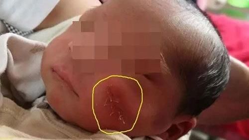 剖腹產手術失誤　醫師劃傷女寶寶左臉