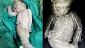 嬰兒雙腳相連如「美人魚」　出生15分鐘就夭折翻攝英國《太陽報》