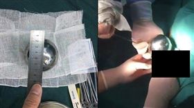 女下體取出巨大鐵球…遭醫護偷拍PO網譏笑　畫面流出挨轟
翻攝微博