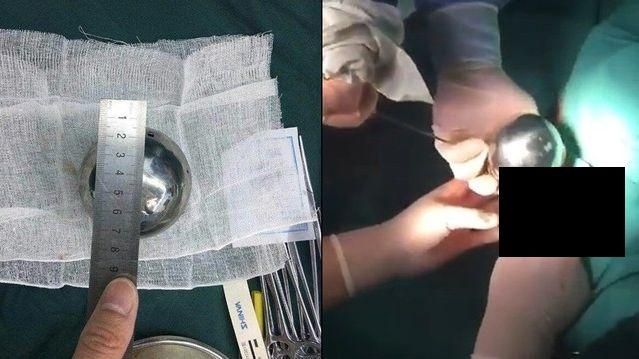 女下體取出大鐵球…遭偷拍PO網譏笑