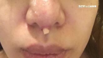 隆鼻「整」到自己　植入物穿出成噩夢