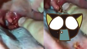 扁桃腺,結石,Liveleak,膿皰,口腔,痘痘,口臭,美國,噁心,驚悚,恐怖,爆發 圖／翻攝自Liveleak　https://goo.gl/iayTpY