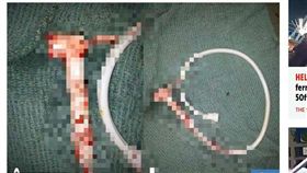 印度,男子,蓮蓬頭,肛門,插下體,性癖好（圖／翻攝自《太陽報》）