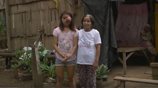 異形巨瘤纏臉　正妹慘淪「半臉貞子」