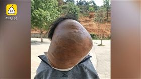 中國大陸老伯頸上長了巨大腫瘤（圖／翻攝自梨視頻）