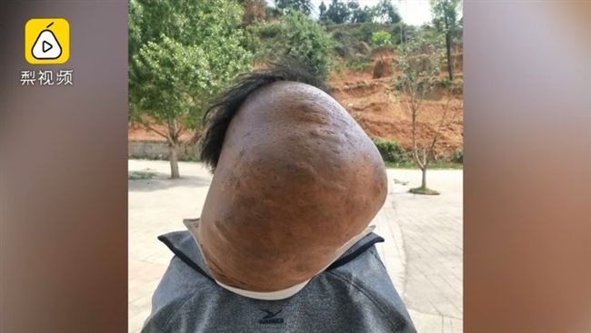 揹百公分巨瘤近半世紀　老伯痛不欲生