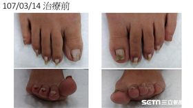 一名42歲櫃姐工作長久站立竟站出凍甲，腳趾變形如雞爪。（圖／萬芳醫院提供）