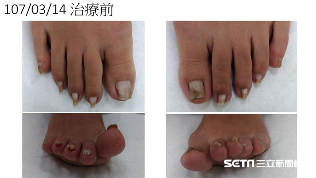 凍甲好痛！櫃姐工作久站竟長腳雞爪