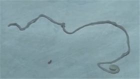 手術,抽搐,寄生蟲,腦,曼氏裂頭絛蟲,生肉,生食,青蛙,飲用水,煮沸,煮熟,大陸,廣東,佛山　圖／翻攝自梨視頻　https://goo.gl/REqa6E