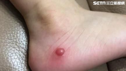 夢靨！蚊蟲叮咬　腳上出現1顆水泡…