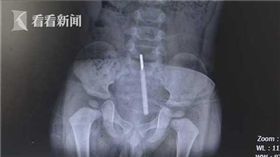 1歲半男童量肛溫亂動，體溫計不慎插入屁股。（圖／翻攝看看新聞）