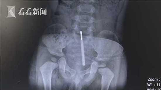 1歲半男童量肛溫　把溫度計坐入直腸