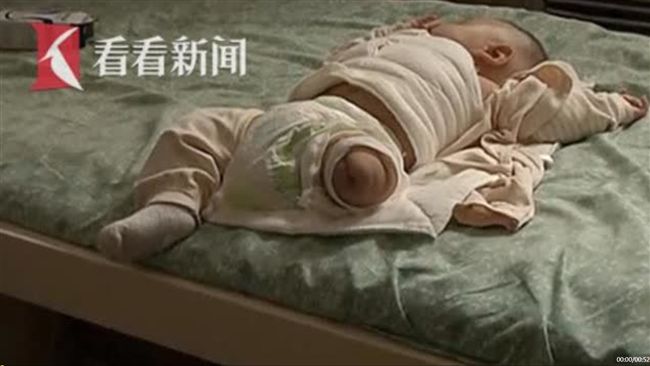 護理師忘關吹風機1小時　早產嬰截肢