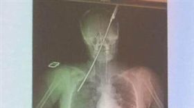 大陸女子眼窩遭傘骨穿刺。（圖／翻攝自中新網）