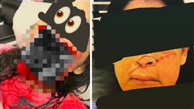 一名女子在路上被人用彎刀襲擊，鼻子幾乎都被削下來，但她卻冷靜地拉著「半張臉」，被人送往醫院。最後女子透過手術，達到零張力的縫合，面部恢復的相當好。（圖／翻攝自微博）