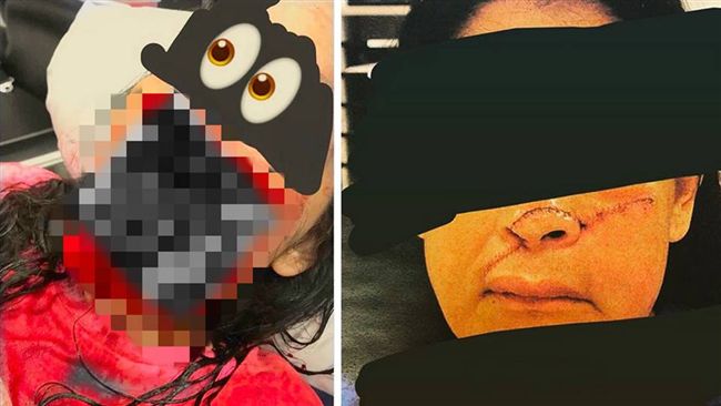 鼻子被彎刀削下…她拉「半張臉」就醫