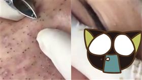 粉刺,黑頭,皮膚,洗臉,衛生,油炸,治療,健康,飲食,泰國,曼谷　圖／翻攝自YouTube https://goo.gl/kUaoH8