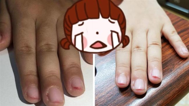 幼兒園動私刑？女童十指見血見肉喊痛