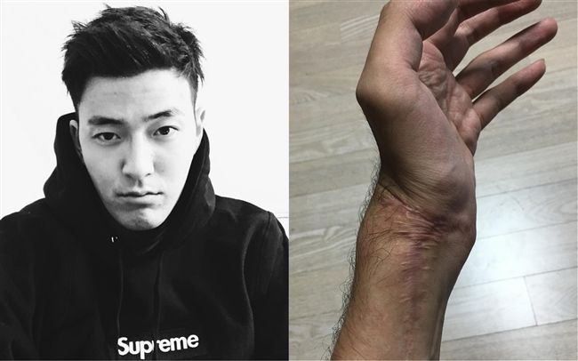 手遭玻璃割斷接回　男星曝惡化恐截肢