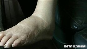 劉奶奶治療前照片(腿腫脹)。（圖／國泰醫院提供）