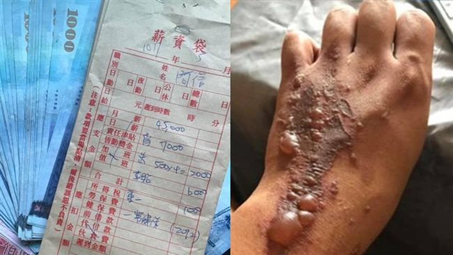 秀薪水條被羨慕　他手上水泡揭多血汗