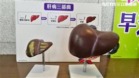 肝病三部曲，「肝炎、肝硬化、肝癌」（圖／記者楊晴雯攝）