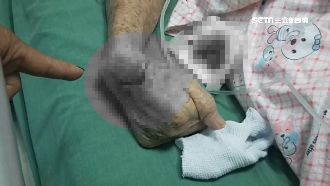 9旬婦轉院遭割傷　家屬控救護員疏失