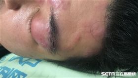 南投醫院皮膚科醫師李瑜芬說，目前尚無文獻研究指出民俗療法「斬蛇」能夠治癒帶狀皰疹。（圖／南投醫院提供）