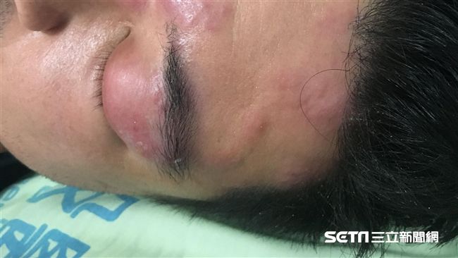 「斬蛇」治皮蛇？醫警告恐致傷口感染