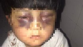 ▲女童眼周腫脹幾乎無法睜眼（圖／翻攝自貴陽頭條排行榜微博）