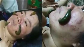 水蛭,敷臉,痘痘,痘疤,美容師,古療法,皺紋,细菌,醫學,NHS,皮膚　圖／翻攝自LiveLeak https://goo.gl/pq1qsX