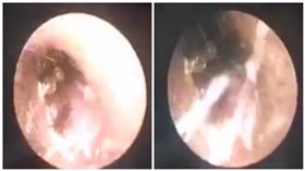 中國大陸深圳一名男子的耳朵跑進一隻蟑螂（圖／翻攝自微博）